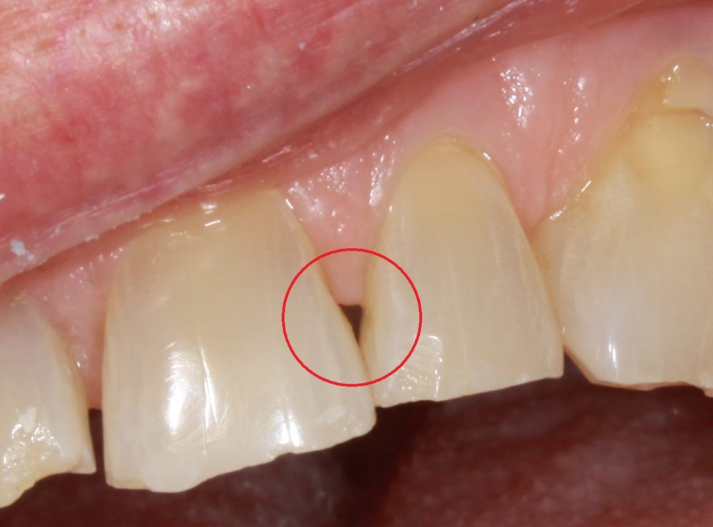 cavity spaces tooth molars