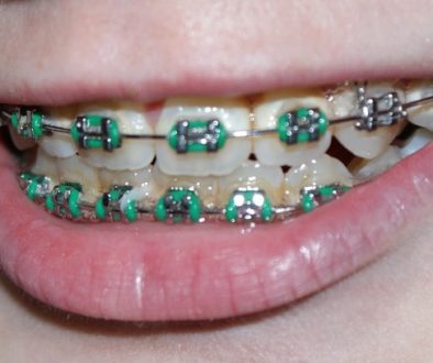 braces